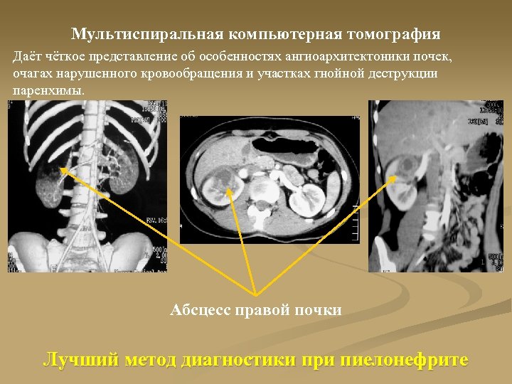 Мультиспиральная компьютерная томография Даёт чёткое представление об особенностях ангиоархитектоники почек, очагах нарушенного кровообращения и