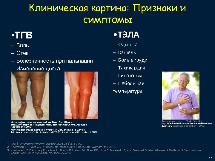 Клиническая картина: Признаки и симптомы • ТГВ • ТЭЛА – – – Одышка –