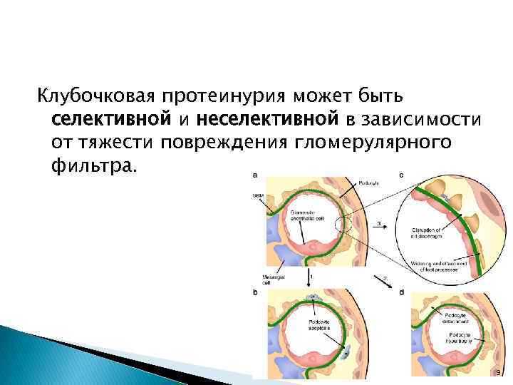 Клубочковая протеинурия может быть селективной и неселективной в зависимости от тяжести повреждения гломерулярного фильтра.