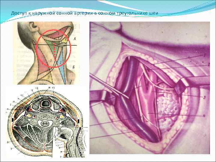 Доступ к наружной сонной артерии в сонном треугольнике шеи 