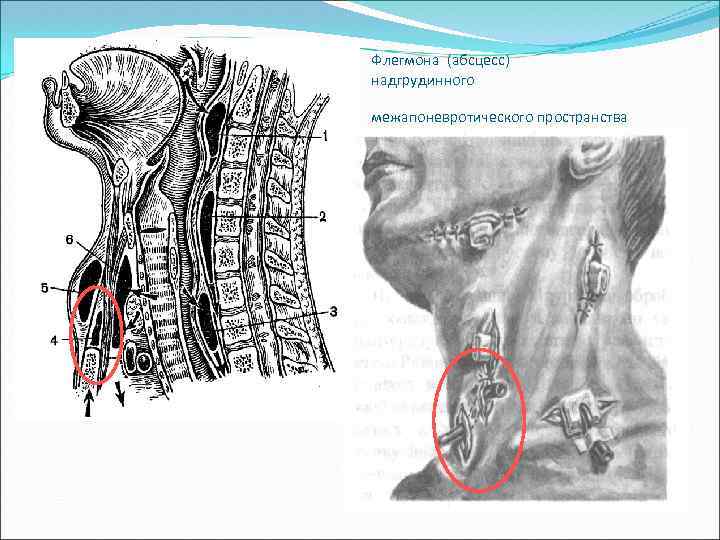 Флегмона шеи карта вызова
