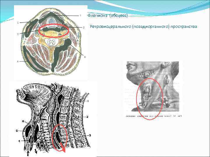 Флегмона (абсцесс) Ретровисцерального (позадиорганного) пространства 