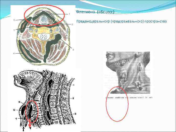 Флегмона (абсцесс) Предвисцеральногр (предтрахеального) пространства 