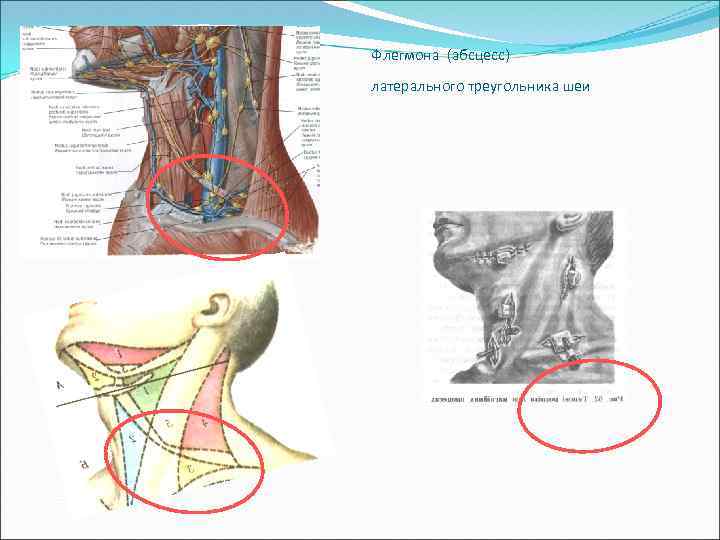 Абсцесс шеи фото