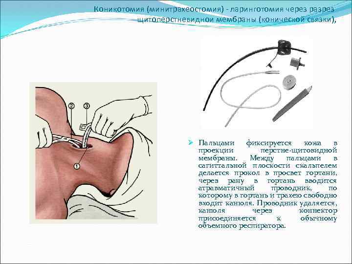 Коникотомия (минитрахеостомия) - ларинготомия через разрез щитоперстневиднои мембраны (конической связки), Ø Пальцами фиксируется кожа