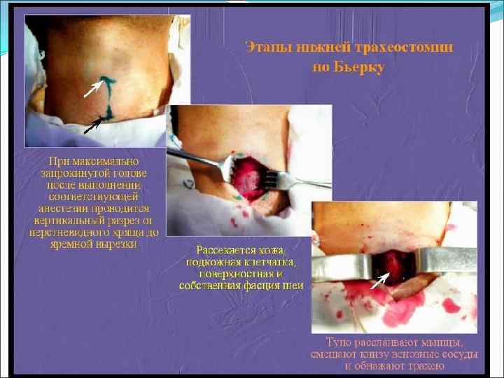 Специальные инструменты для трахеостомии 