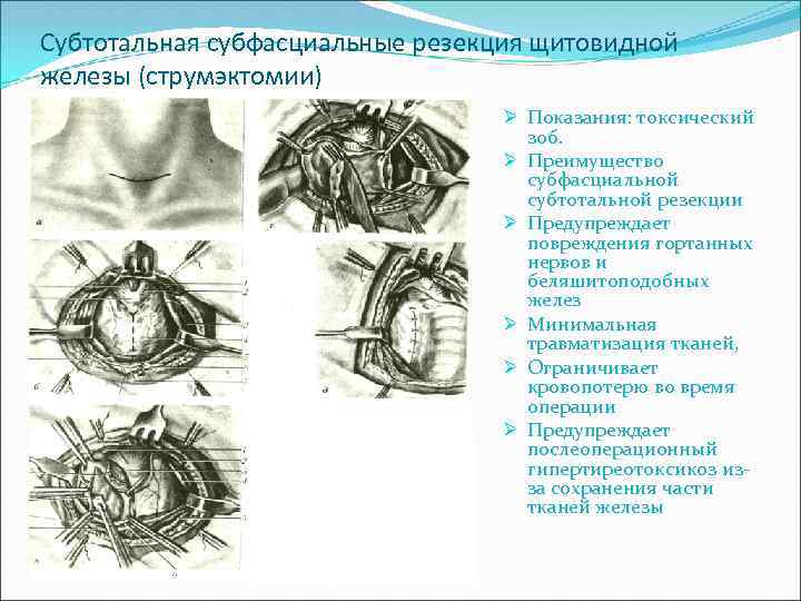 Субтотальная субфасциальные резекция щитовидной железы (струмэктомии) Ø Показания: токсический зоб. Ø Преимущество субфасциальной субтотальной