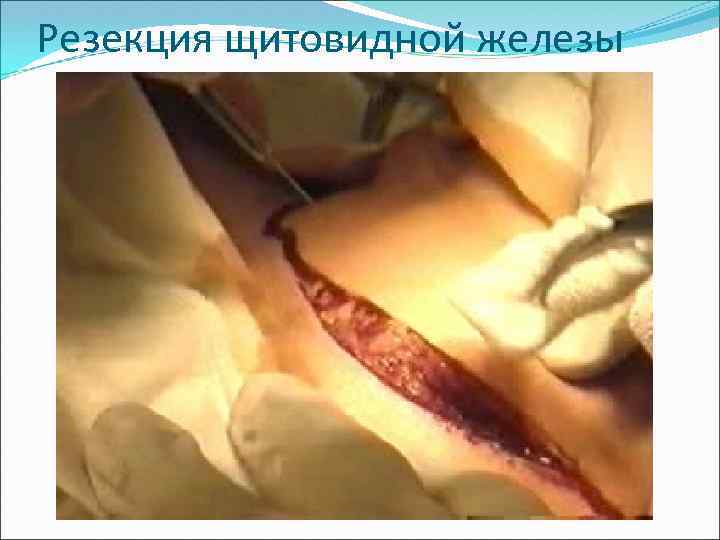Резекция щитовидной железы 