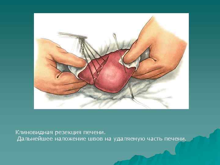 Клиновидная резекция печени. Дальнейшее наложение швов на удаляемую часть печени. 