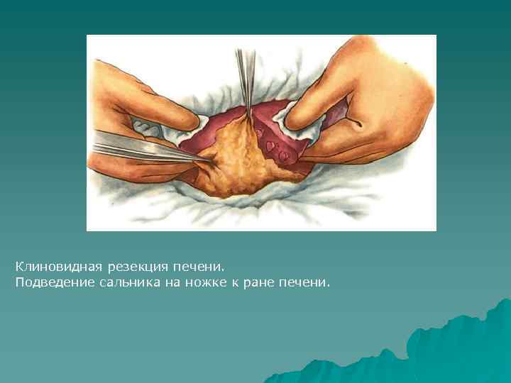 Клиновидная резекция печени. Подведение сальника на ножке к ране печени. 