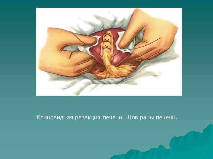 Клиновидная резекция печени. Шов раны печени. 