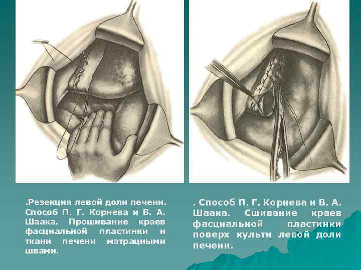 . Резекция левой доли печени. Способ П. Г. Корнева и В. А. Шаака. Прошивание