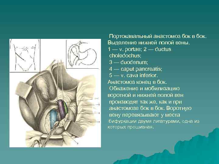 Портокавальный анастомоз бок в бок. Выделение нижней полой вены. 1 — v. portae; 2