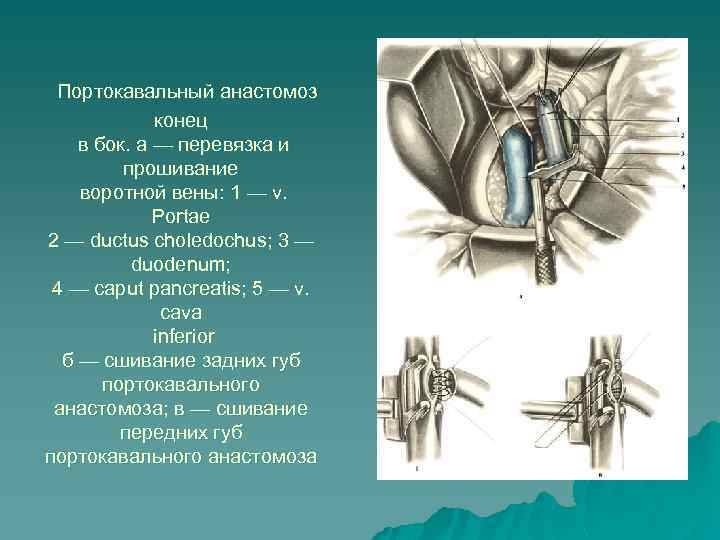 Портокавальный анастомоз конец в бок. а — перевязка и прошивание воротной вены: 1 —