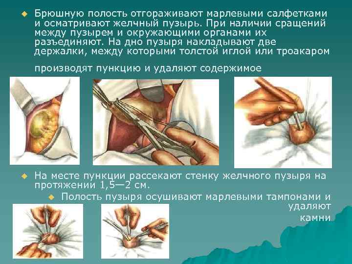 u Брюшную полость отгораживают марлевыми салфетками и осматривают желчный пузырь. При наличии сращений между