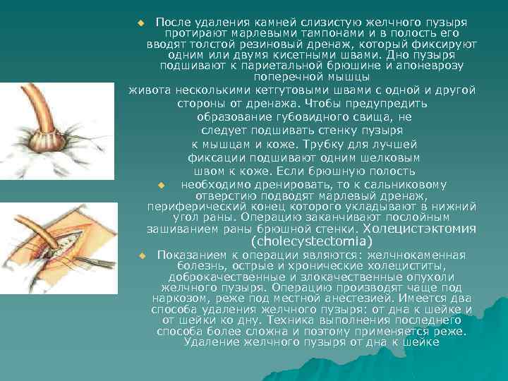 После удаления камней слизистую желчного пузыря протирают марлевыми тампонами и в полость его вводят