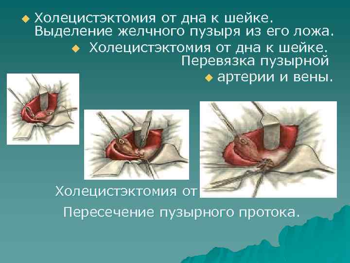 u Холецистэктомия от дна к шейке. Выделение желчного пузыря из его ложа. u Холецистэктомия