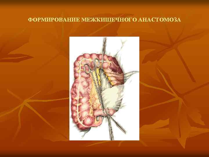 ФОРМИРОВАНИЕ МЕЖКИШЕЧНОГО АНАСТОМОЗА 