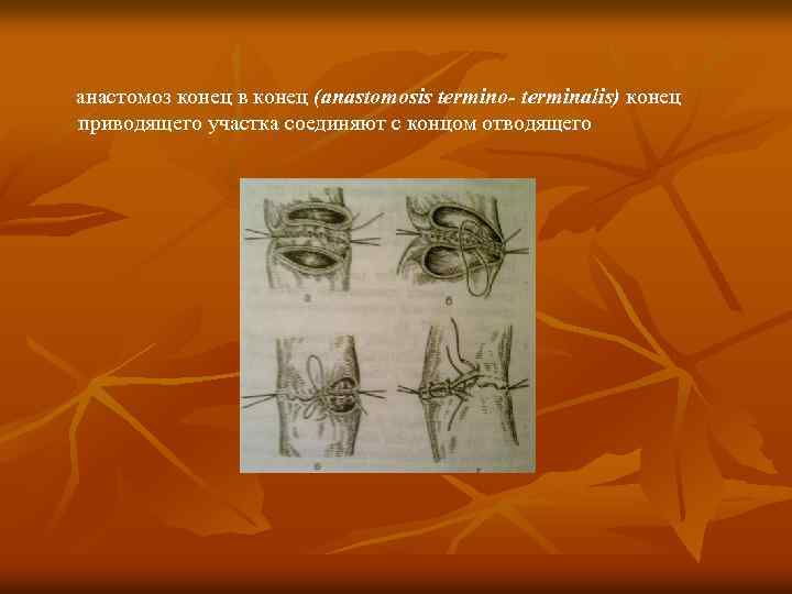 анастомоз конец в конец (anastomosis termino- terminalis) конец приводящего участка соединяют с концом отводящего