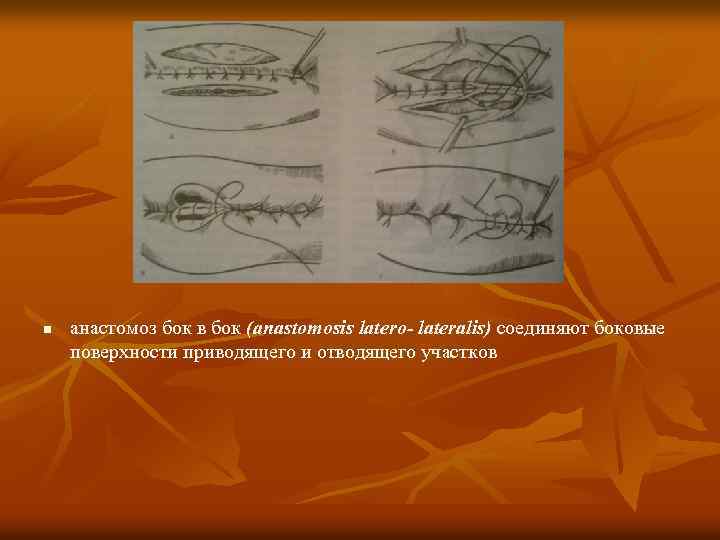 n анастомоз бок в бок (anastomosis latero- lateralis) соединяют боковые поверхности приводящего и отводящего