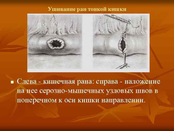 Ушивание ран тонкой кишки n Слева кишечная рана: справа наложение на нее серозно мышечных