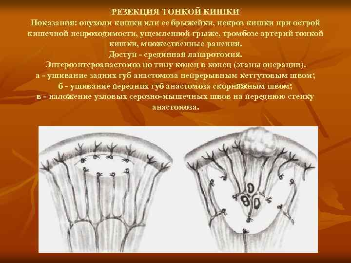 РЕЗЕКЦИЯ ТОНКОЙ КИШКИ Показания: опухоли кишки или ее брыжейки, некроз кишки при острой кишечной