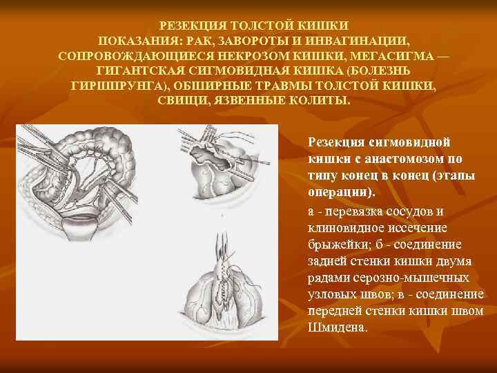 РЕЗЕКЦИЯ ТОЛСТОЙ КИШКИ ПОКАЗАНИЯ: РАК, ЗАВОРОТЫ И ИНВАГИНАЦИИ, СОПРОВОЖДАЮЩИЕСЯ НЕКРОЗОМ КИШКИ, МЕГАСИГМА — ГИГАНТСКАЯ