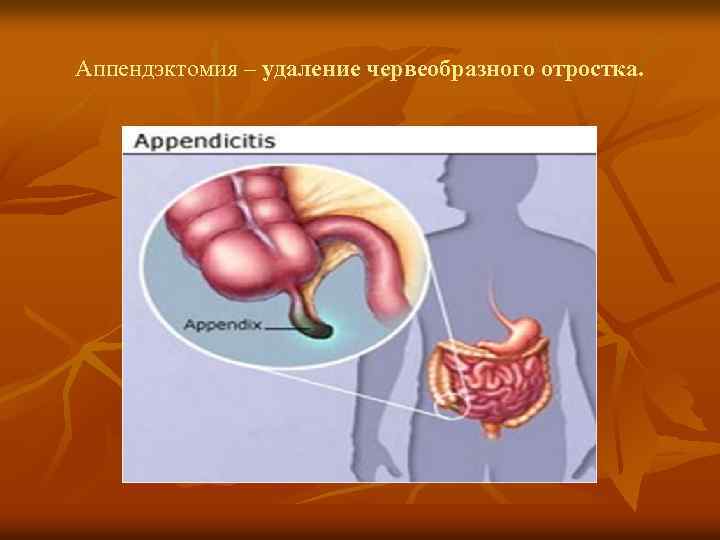 Аппендэктомия – удаление червеобразного отростка. 