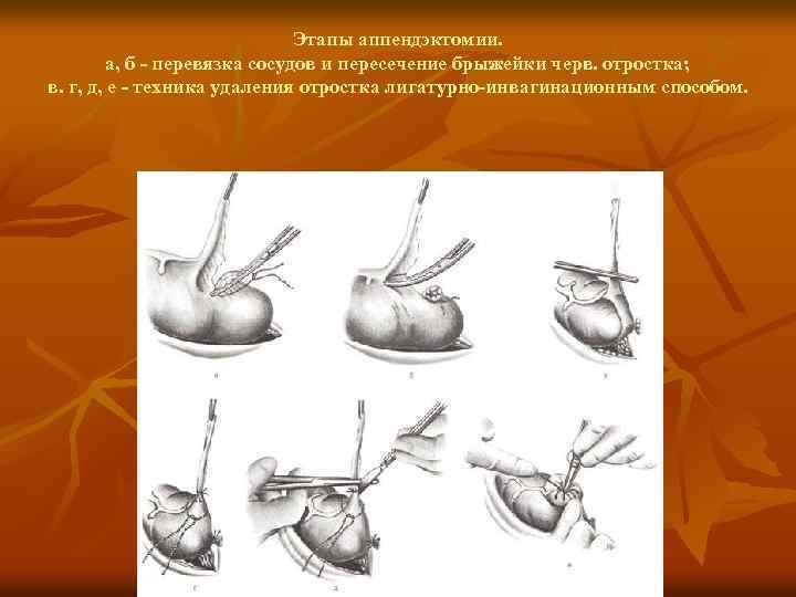 Этапы аппендэктомии. а, б - перевязка сосудов и пересечение брыжейки черв. отростка; в. г,