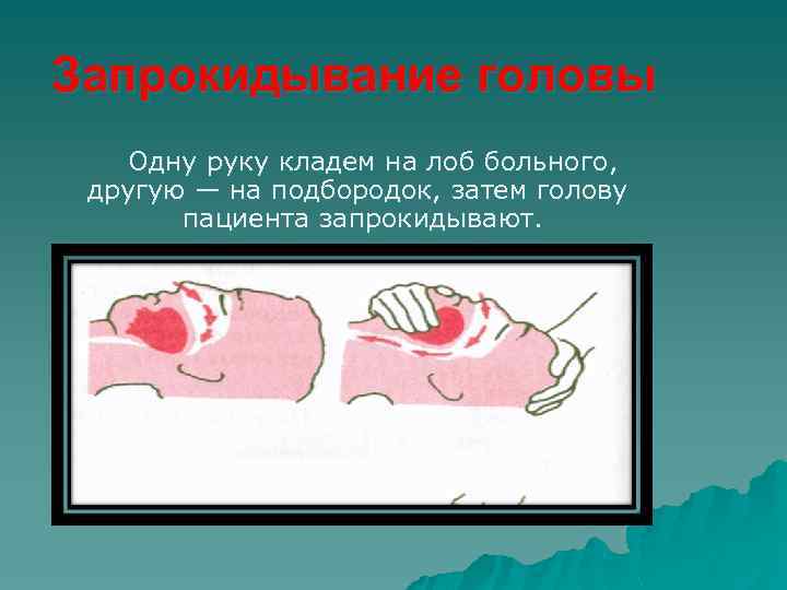 Запрокидывание головы Одну руку кладем на лоб больного, другую — на подбородок, затем голову