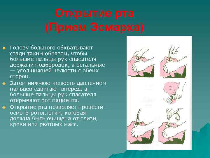 Открытие рта (Прием Эсмарха) u u u Голову больного обхватывают сзади таким образом, чтобы