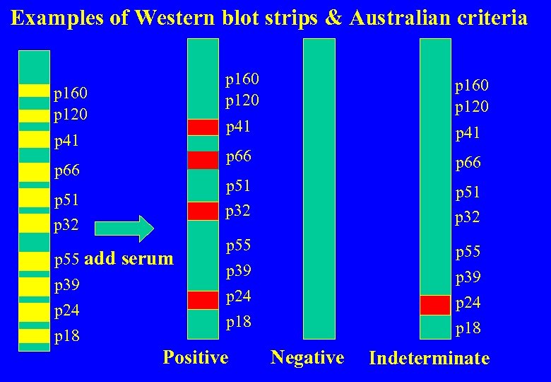 Examples of Western blot strips & Australian criteria p 160 p 120 p 51