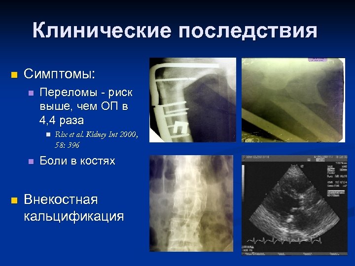 Клинические последствия n Симптомы: n Переломы - риск выше, чем ОП в 4, 4