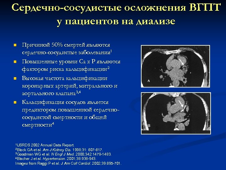 Сердечно-сосудистые осложнения ВГПТ у пациентов на диализе n n Причиной 50% смертей являются сердечно-сосудистые