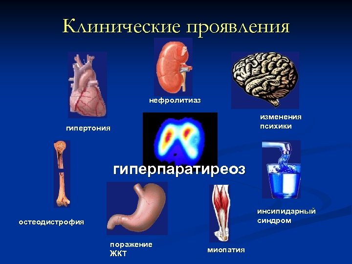 Клинические проявления нефролитиаз изменения психики гипертония гиперпаратиреоз инсипидарный синдром остеодистрофия поражение ЖКТ миопатия 