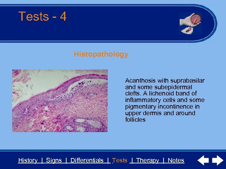 Tests - 4 Histopathology Acanthosis with suprabasilar and some subepidermal clefts. A lichenoid band