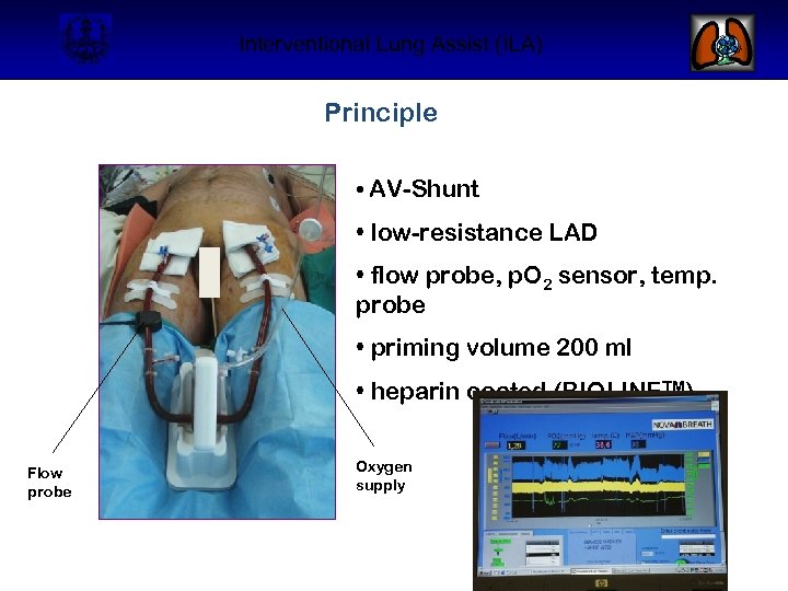 Interventional Lung Assist (ILA) Principle • AV-Shunt • low-resistance LAD • flow probe, p.