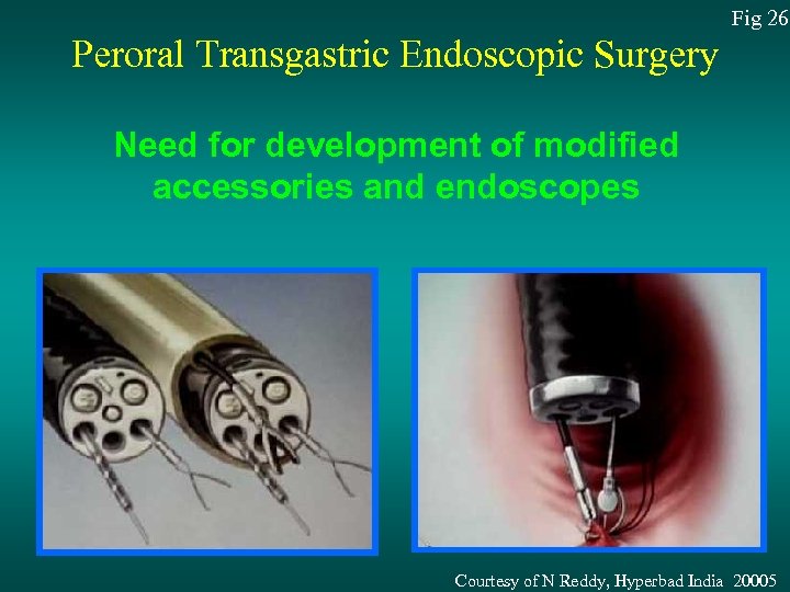 Fig 26 Peroral Transgastric Endoscopic Surgery Need for development of modified accessories and endoscopes