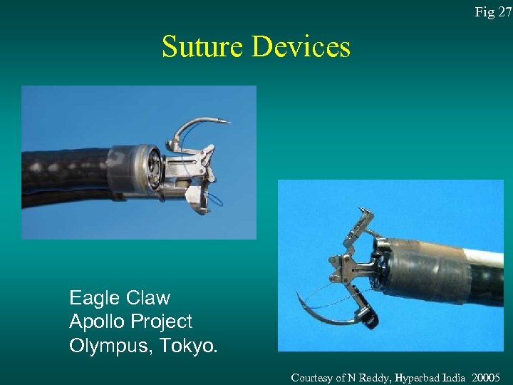 Fig 27 Suture Devices Eagle Claw Apollo Project Olympus, Tokyo. Courtesy of N Reddy,