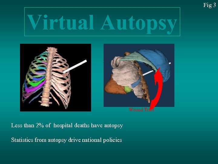 Fig 3 Virtual Autopsy Wound Tract Less than 2% of hospital deaths have autopsy