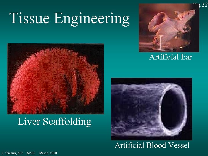 Fig 52 Tissue Engineering Artificial Ear Liver Scaffolding Artificial Blood Vessel J. Vacanti, MD
