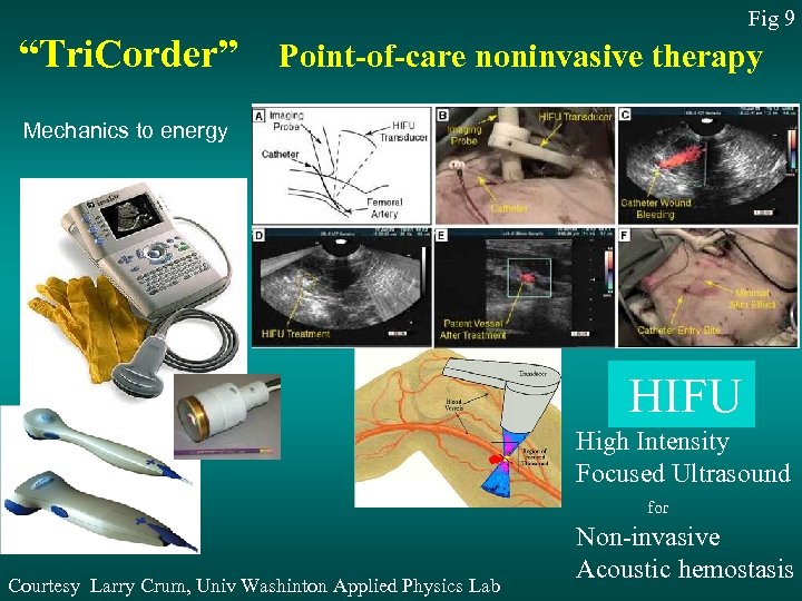 Fig 9 “Tri. Corder” Point-of-care noninvasive therapy Mechanics to energy HIFU Courtesy Larry Crum,