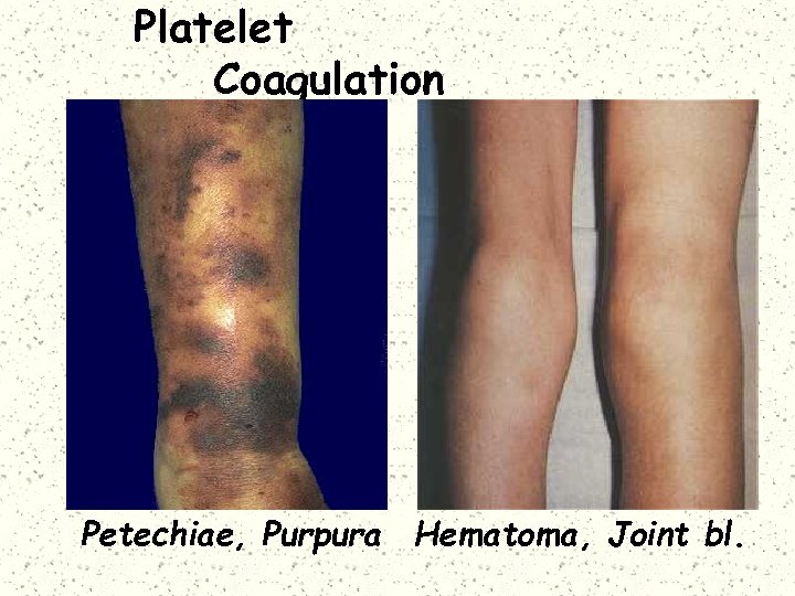 Platelet Coagulation Petechiae, Purpura Hematoma, Joint bl. 