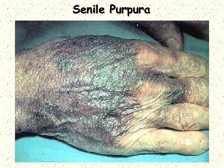 Senile Purpura 