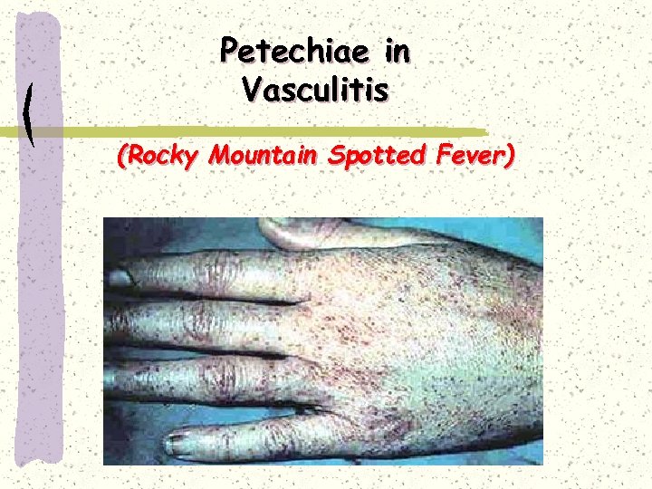 Petechiae in Vasculitis (Rocky Mountain Spotted Fever) 