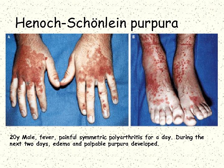 Henoch-Schönlein purpura 20 y Male, fever, painful symmetric polyarthritis for a day. During the