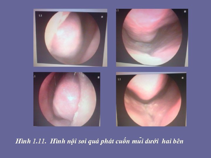 Hình 1. 11. Hình nội soi quá phát cuốn mu i dưới hai bên