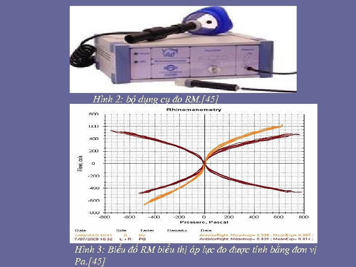 Hình 2: bộ dụng cụ đo RM. [45] Hình 3: Biểu đồ RM biểu