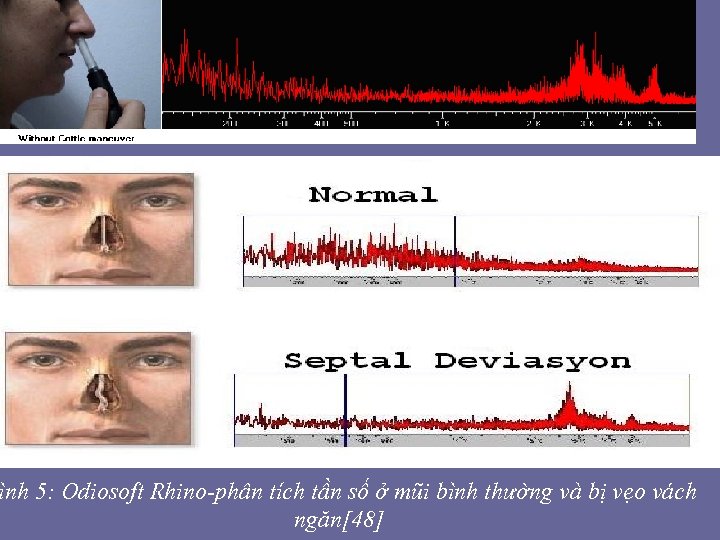 ình 5: Odiosoft Rhino-phân tích tần số ở mũi bình thường và bị vẹo