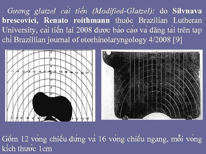 Gương glatzel ca i tiê n (Modified-Glatzel): do Silvnava brescovici, Renato roithmann thuô c